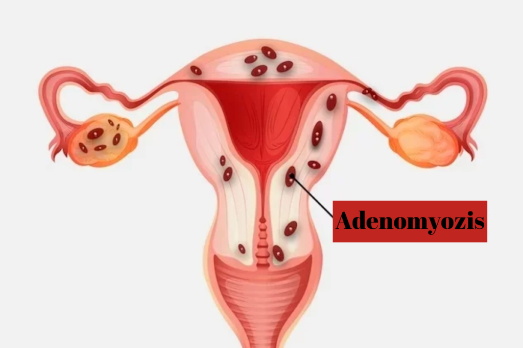 Adenomyozis Nedir, Neden Olur?