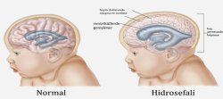 Anne Karnında Hidrosefali
