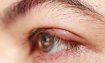 Göz Şişmesi Nasıl Geçer? Ağladıktan ve Darbe Sonrası, Alerjik Göz Şişmesine Çare