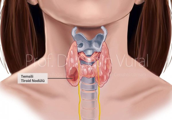 Tiroid Hastalığı Nedir?